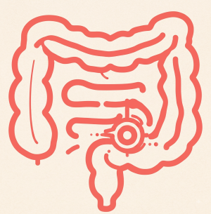 Crohn’s Disease