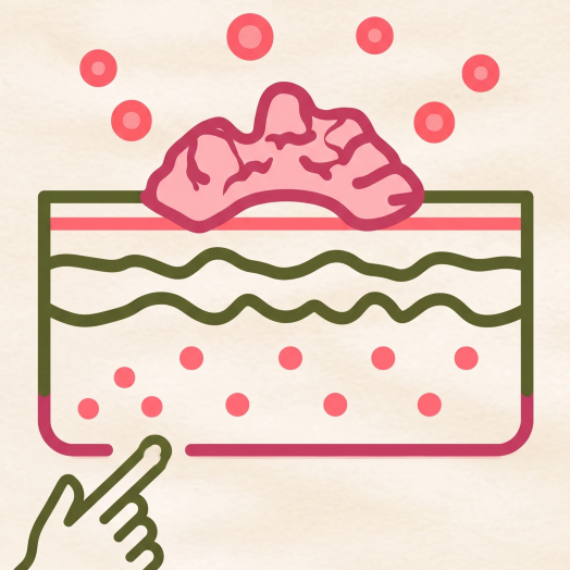 Psoriasis