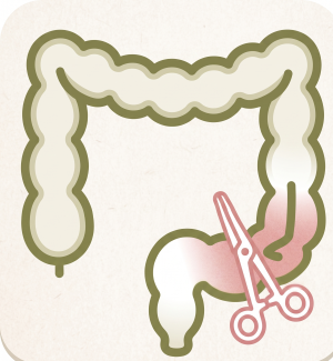 Ulcerative Colitis