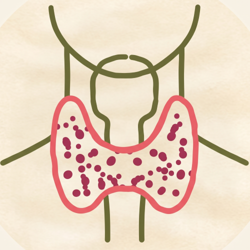 Hashimoto’s thyroiditis